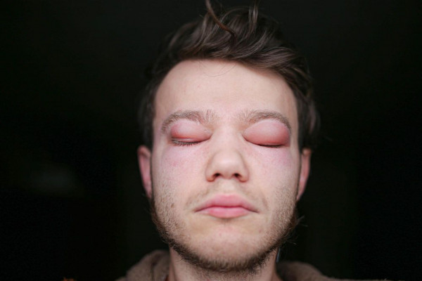 Angioedema, angioedema adalah, apa itu angioedema, penyebab angioedema, kode icd 10 angioedema, angioedema bibir, angioedema herediter, angioedema treatment, yesdok