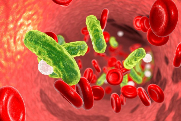penyakit sepsis adalah, penyebab sepsis, sepsis adalah penyakit, infeksi sepsis, tanda tanda sepsis, virus sepsis, diagnosa sepsis adalah, sepsis symptoms, yesdok