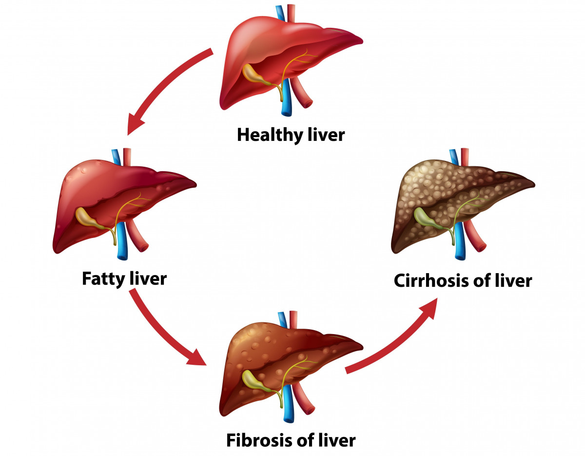 patofisiologi sirosis hepatis, klasifikasi sirosis hepatis, manifestasi klinis sirosis hepatis, tanda dan gejala sirosis hepatis, contoh kasus sirosis hepatis, kriteria sirosis hepatis, yesdok