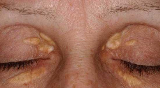 Xanthelasma, xanthelasma adalah, cara menghilangkan xanthelasma, penyebab xanthelasma, operasi xanthelasma, apakah xanthelasma bisa hilang, jenis xanthelasma, yesdok