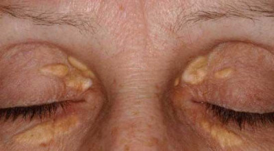 XANTHELASMA: PLAK KUNING DI SUDUT MATA, SIMAK PENYEBABNYA YUK!