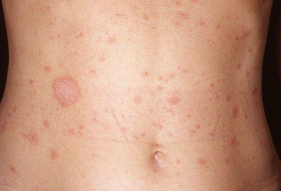 PITYRIASIS ROSEA: RASA GATAL DISERTAI BULATAN MERAH, SIMAK PENYEBABNYA YUK!