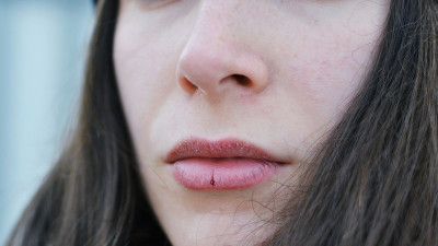 Mengapa Kulit Bibir Anda Kering?