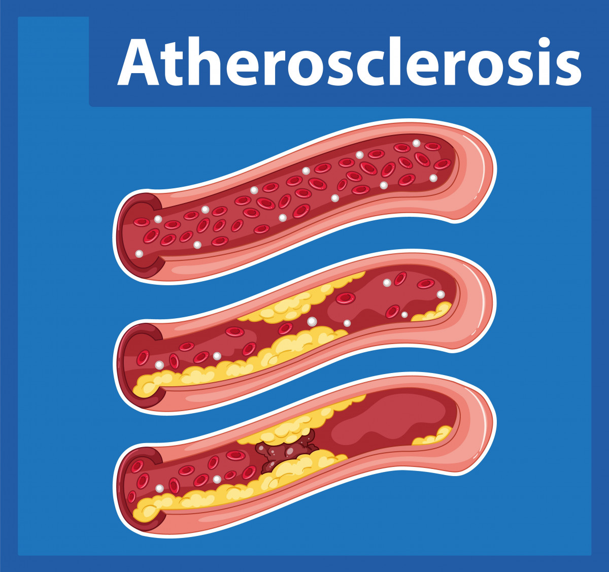 Aterosklerosis, gorengan, pembuluh, darah
