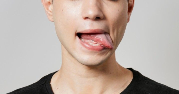 sariawan, sariawan di bawah lidah, sariawan di lidah, penyebab sariawan, gejala sariawan, penanganan sariawan,  yesdok