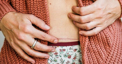 Keloid Muncul Pasca Caesar, Benarkah?
