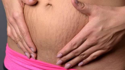 Cara Alami Hilangkan Stretch Mark
