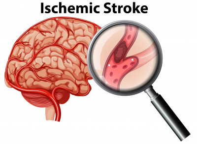 Stroke Iskemik Itu Apa? Ini 6 Faktanya