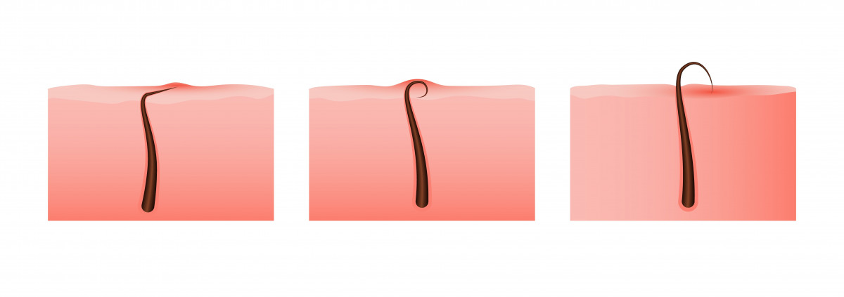 ingrown hair, ingrown pubic hair, bulu kemaluan tumbuh kedalam, ingrown hair di miss v, yesdok