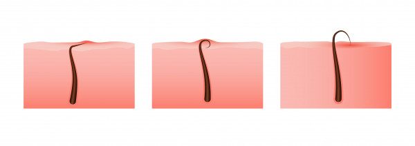 ingrown hair, ingrown pubic hair, bulu kemaluan tumbuh kedalam, ingrown hair di miss v, yesdok