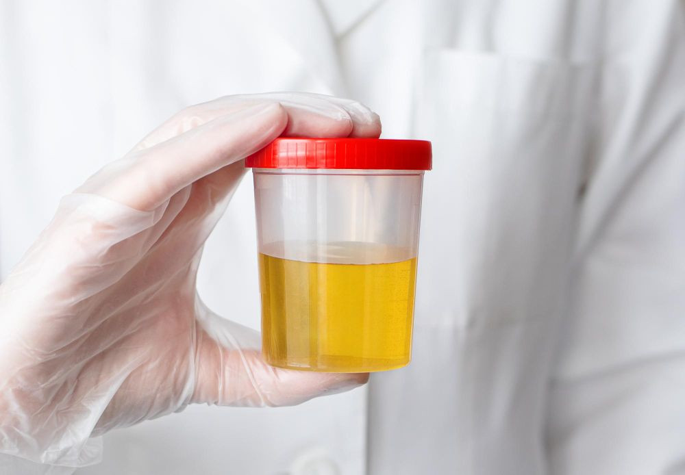 warna urine normal dan abnormal, warna urine yang sehat, warna urine ibu hamil, penyebab urine berwarna kuning, mengapa urine berwarna kuning, warna normal urine, warna urine dan artinya, yesdok