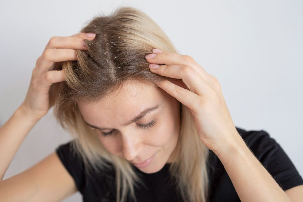 Ketombe, kulit kepala kering, minyak di kulit kepala, dehidrasi, kulit terkelupas, dermatitis seboroik, psoriasis, sampo anti ketombe, produk kimia rambut, kulit kepala gatal, dermatitis kontak, yesdok