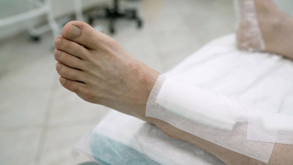 Cara menyembuhkan gangrene, gangrene adalah, mengatasi luka gangren, luka gangren adalah, apa itu gangrene, gangrene icd 10, luka gangren diabetes, penyebab gangren, gejala gangren, yesdok