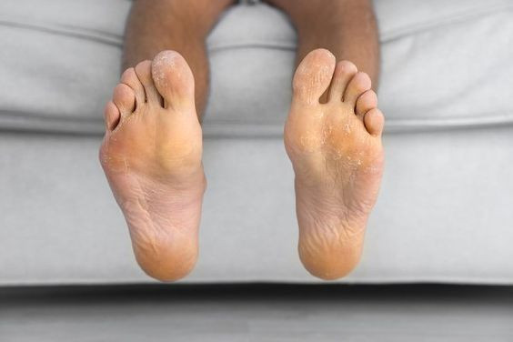 Gejala keratoderma, keratoderma adalah, palmoplantar keratoderma, plantar keratoderma, keratoderma penyebab, keratoderma causes, keratoderma palmoplantar adalah, yesdok