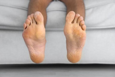 Keratoderma Itu Apa? Ini 5 Gejalanya