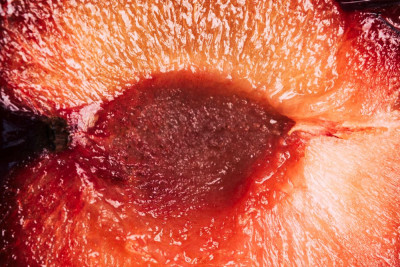 Hematoma Vulva Penyebab Vagina Bengkak, Ini 5 Penyebab Lainnya