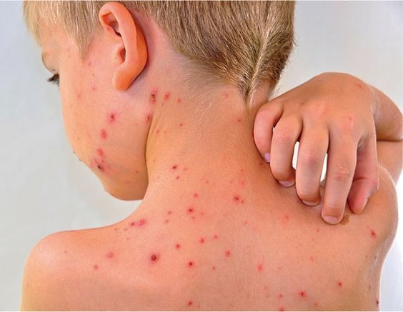 cacar air gejala, kenapa bisa terkena cacar air, penyebab penyakit cacar air, ciri2 cacar air, bintik awal cacar air, cacar air pada dewasa, sakit cacar air, nama virus penyebab cacar air, contoh cacar air, yesdok