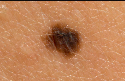 Kenali Penyakit Melanoma