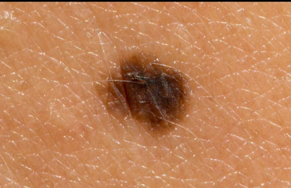 Kenali Penyakit Melanoma