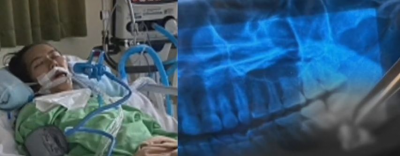 Wanita Meninggal Usai Operasi Cabut Gigi, Waspadai 6 Efek Samping Ini