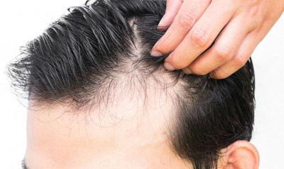 Polusi Udara Sebabkan Kerontokan Rambut