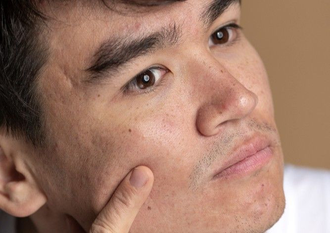 spider veins adalah, penyebab spider veins, kenapa pembuluh darah terlihat di wajah, urat  terlihat jelas, yesdok