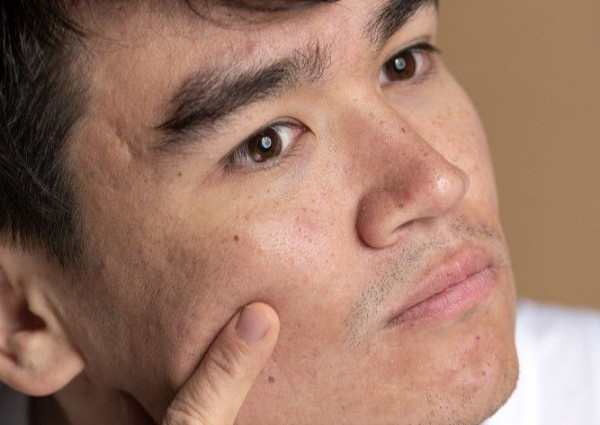 spider veins adalah, penyebab spider veins, kenapa pembuluh darah terlihat di wajah, urat  terlihat jelas, yesdok