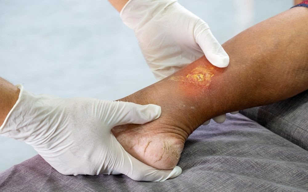 Gangrene, gangrene adalah, luka gangren, luka gangren adalah, apa itu gangrene, gangrene icd 10, luka gangren diabetes, penyebab gangren, gejala gangren, yesdok