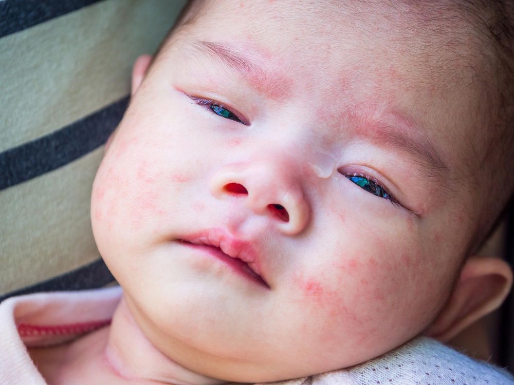 Ruam pada kulit bayi, kemerahan kulit bayi, bintik pada kulit bayi, alergi pada kulit bayi,  penyebab kemerahan pada kulit bayi, kulit bayi, alergi popok, yesdok
