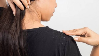 Perawatan Gula untuk Usir Ketombe di Kepala