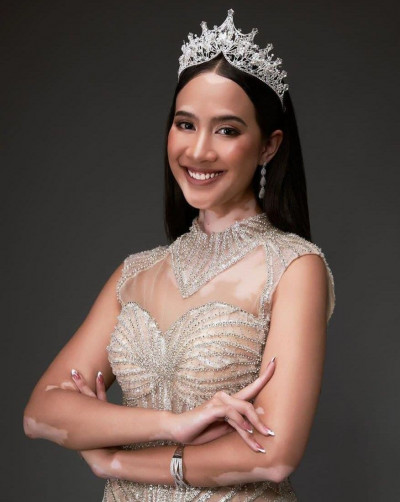 SALMA KYN: VITILIGO BIKIN INSECURE! SIMAK TIPS DARI PUTERI INDONESIA PENGIDAP VITILIGO