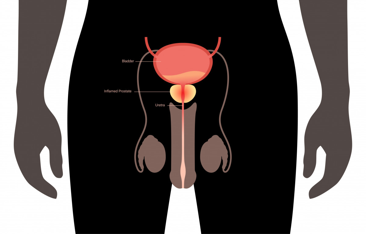 torsio testis, torsio testis adalah, apa itu torsio testis, gejala torsio testis, penyebab torsio testis, ciri ciri torsio testis, torsio testis penyebab, faktor resiko torsio testis, yesdok