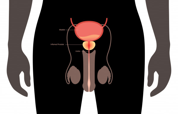 torsio testis, torsio testis adalah, apa itu torsio testis, gejala torsio testis, penyebab torsio testis, ciri ciri torsio testis, torsio testis penyebab, faktor resiko torsio testis, yesdok