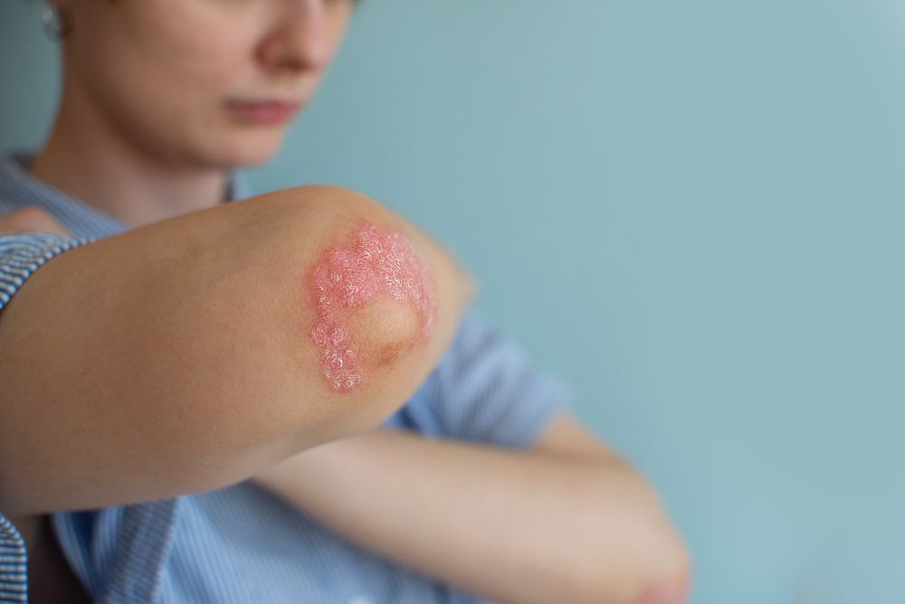 dermatitis numularis, dermatitis numularis adalah, icd 10 dermatitis numularis, dermatitis numularis icd 10, penyebab dermatitis numularis, gejala dermatitis numularis, penanganan dermatitis numularis, yesdok