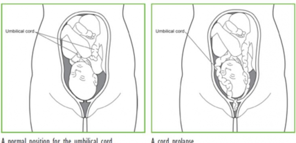 penyebab prolaps tali pusat, prolaps tali pusat adalah, prolaps tali pusat, prolaps tali pusat pdf, penatalaksanaan prolaps tali pusat, definisi prolaps tali pusat, penanganan prolaps tali pusat, pathway prolaps tali pusat, yesdok