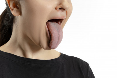 KENALI HAIRY TONGUE, KONDISI TUMBUH BULU DI LIDAH