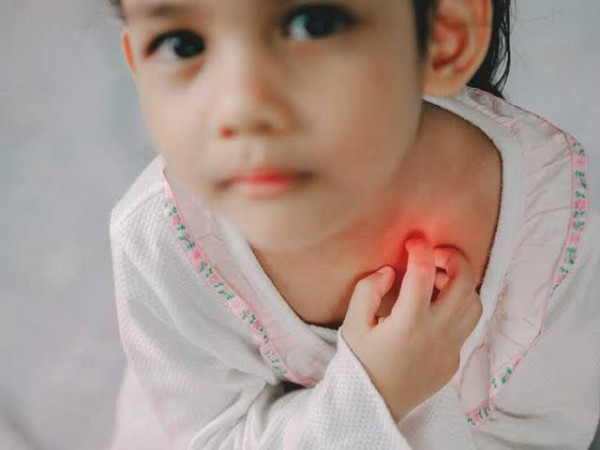 Cara Mudah Atasi Biang Keringat Pada Anak