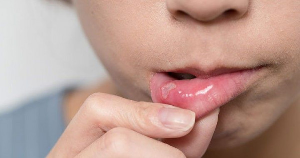 Kenali Mukokel, Benjolan Kista Ringan Di Rongga Mulut