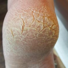 Kulit Telapak Kaki Menebal, Ini 5 Penyebab Keratoderma
