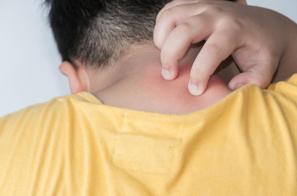 Penyebab Dermatitis Spongiotik dan Perawatannya