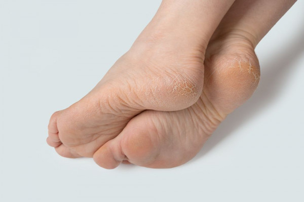 Penyebab rasa gatal di kaki, telapak kaki gatal, pruritus, neuropati perifer, gangguan saraf, kutu air, infeksi jamur, ruam di kaki, kemerahan di telapak kaki, kulit, medis, psikologis, yesdok
