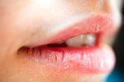 5 Treatment Alami Atasi Mulut Kering