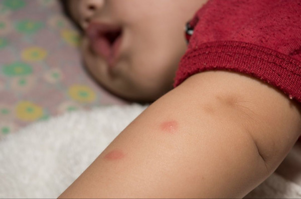 Langkah Tepat Cegah Gigitan Nyamuk pada Anak