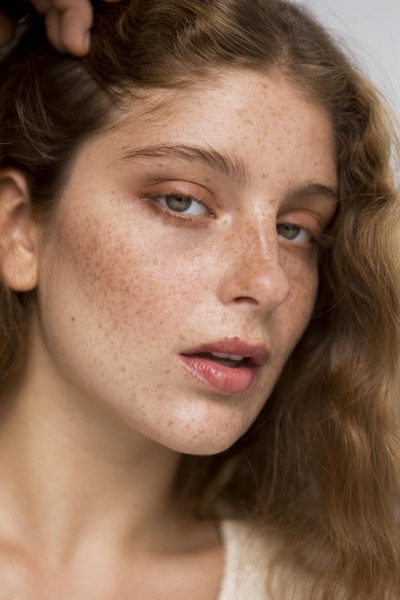 KULIT HIPERPIGMENTASI CARI TAHU PENYEBAB MELASMA