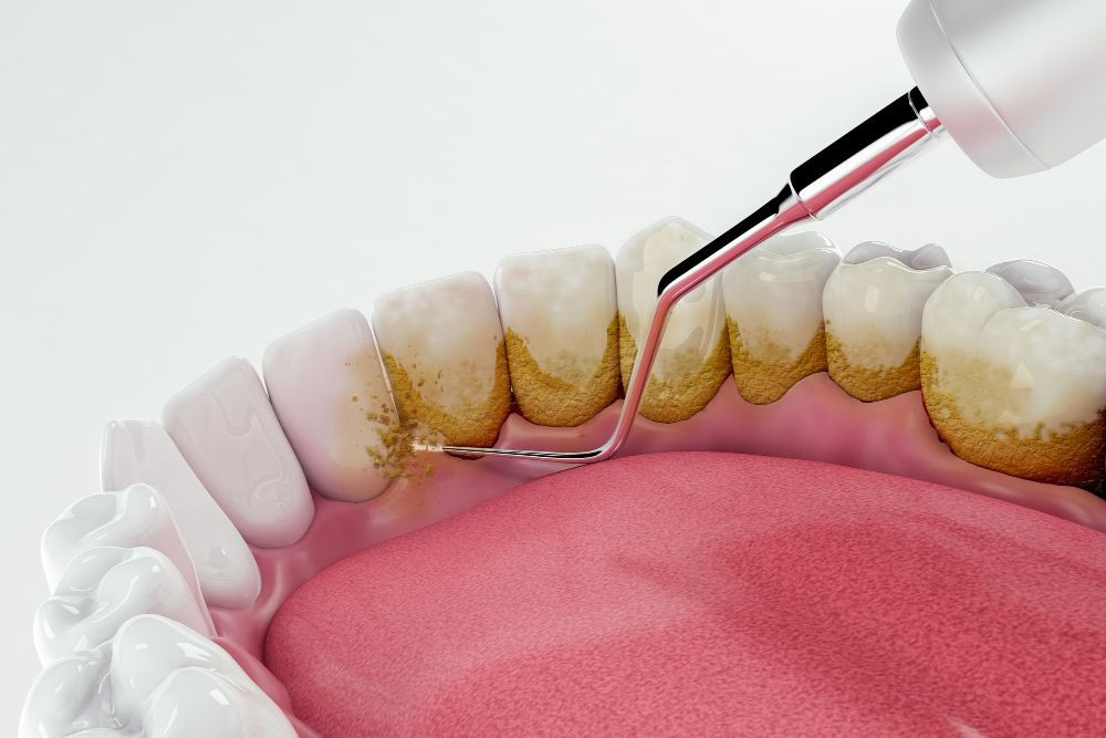 penyebab karang gigi, karang gigi disebabkan oleh, apa penyebab karang gigi, karang gigi menyebabkan, penyebab gigi berkarang, penyebab adanya karang gigi, penyebab munculnya karang gigi, yesdok