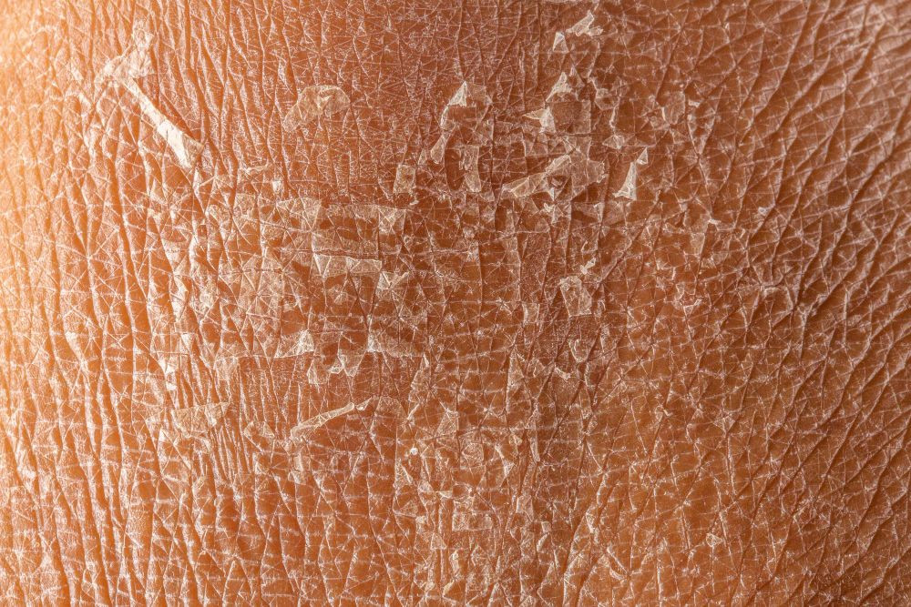 kenapa kulit kering dan gatal, kaki kering bersisik, cara mengatasi kulit kering dan bersisik, kulit kering dan bersisik, kulit bersisik dan kering, penyakit kulit kering bersisik, tangan bersisik, yesdok