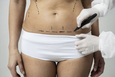INGIN KURUS TAPI MALAS DIET,SEDOT LEMAK AMANKAH?