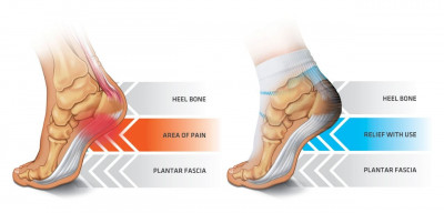 Atasi Sakit Plantar Fasciitis dalam 2 Menit
