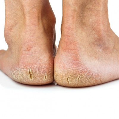 Cara Mengatasi Keratoderma di Telapak Kaki, Simak Yuk