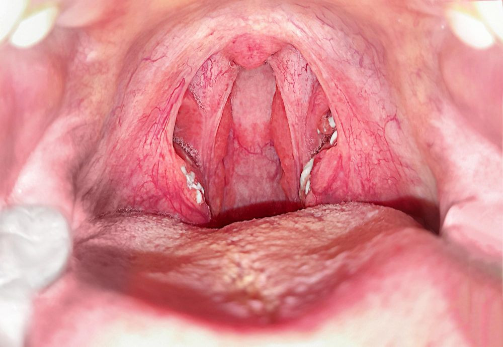 batu amandel, batu amandel bau, penyebab batu amandel, batu amandel adalah, bentuk batu amandel, ciri ciri batu amandel, kenapa batu amandel bau, yesdok